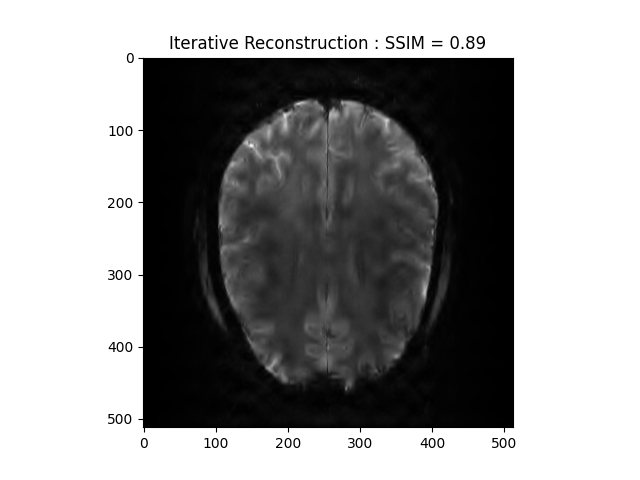 Iterative Reconstruction : SSIM = 0.89
